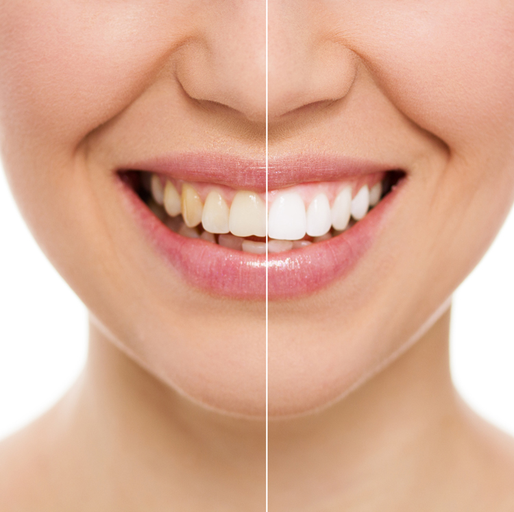 Treatment Options for Yellow Teeth